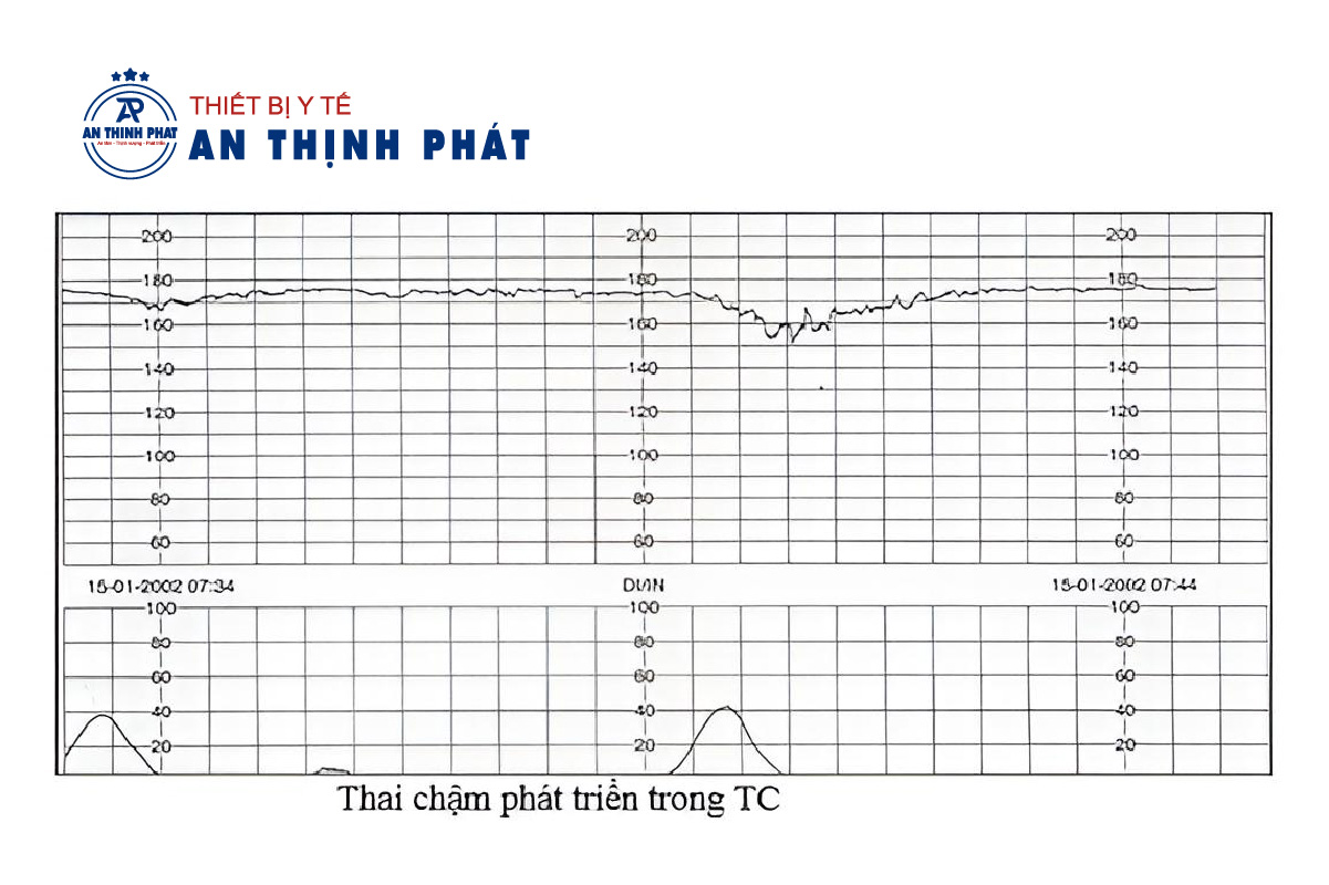 Cách đọc kết quả chạy máy monitor sản khoa